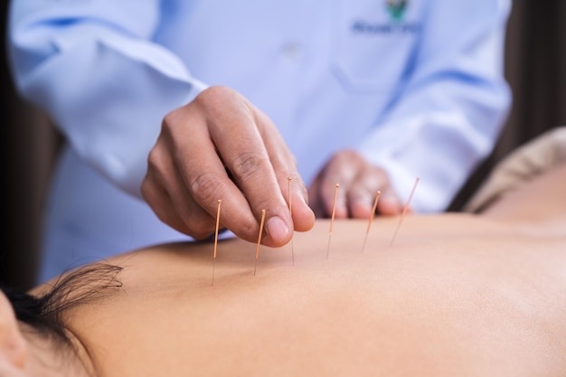 Acupuncture