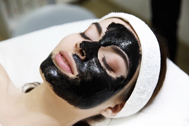 Carbon Laser Peel