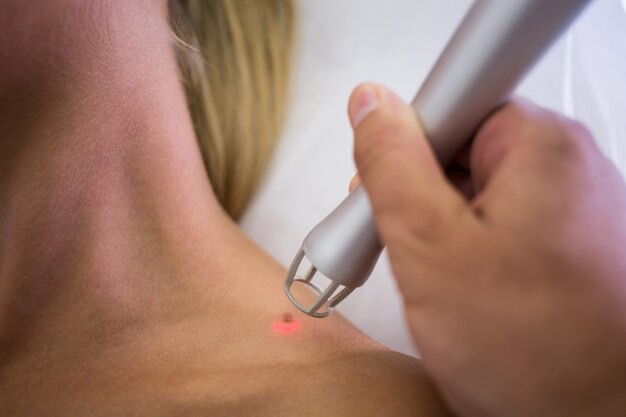 Laser Freckles Removal/Fading